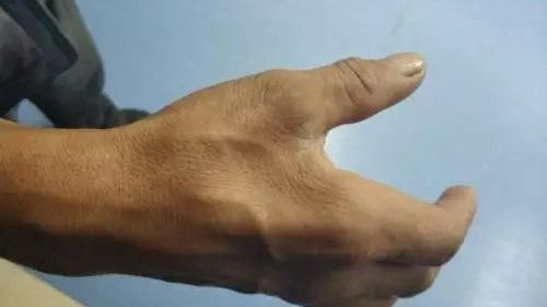 克罗恩病哪家医院看得好-治疗克罗恩病，选对医院是关键！北京、上海、广州医院大比拼